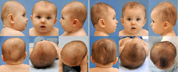 Trẻ sơ sinh bị méo đầu lớn có hết không