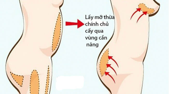 Cấy mỡ mông