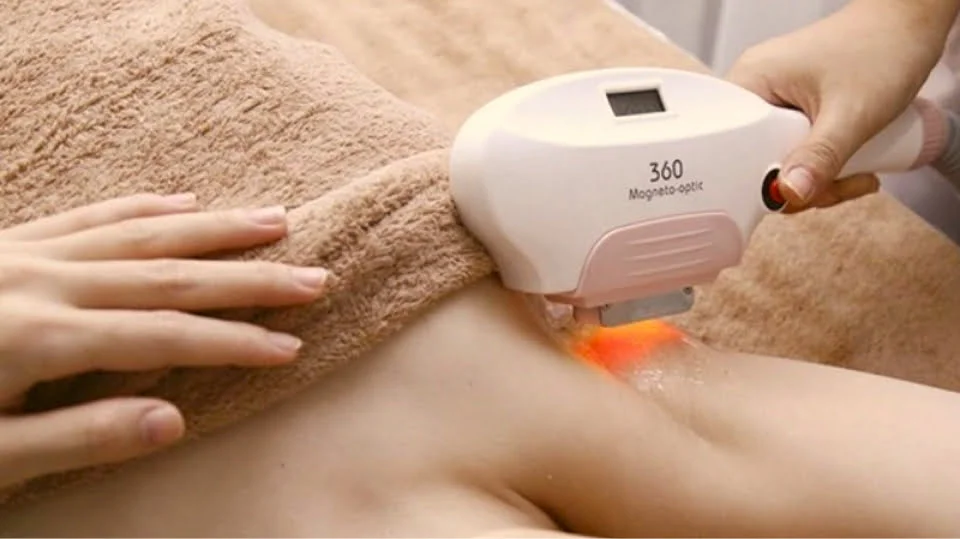 Triệt lông bằng laser