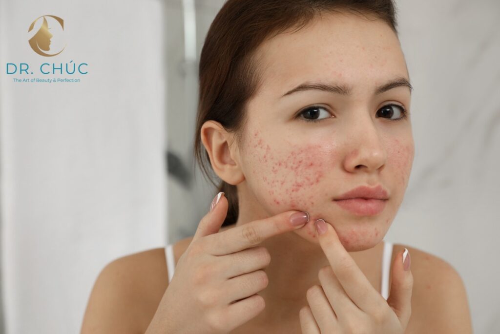 Đặc điểm nhận biết mụn nội tiết
