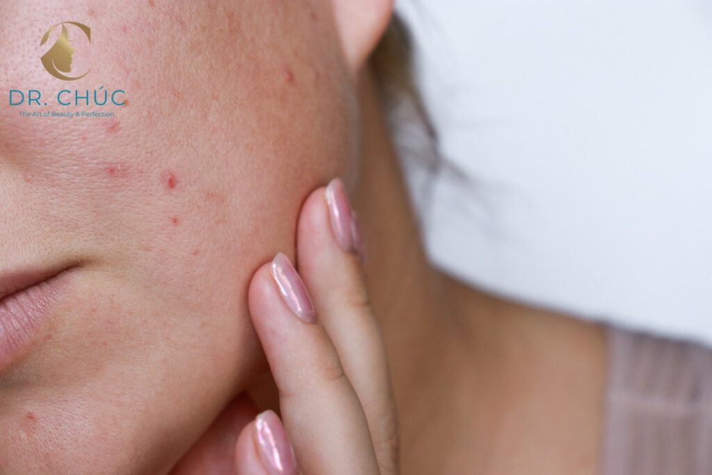 Hiểu lầm 1: Mọi vấn đề về da đều do rối loạn nội tiết tố