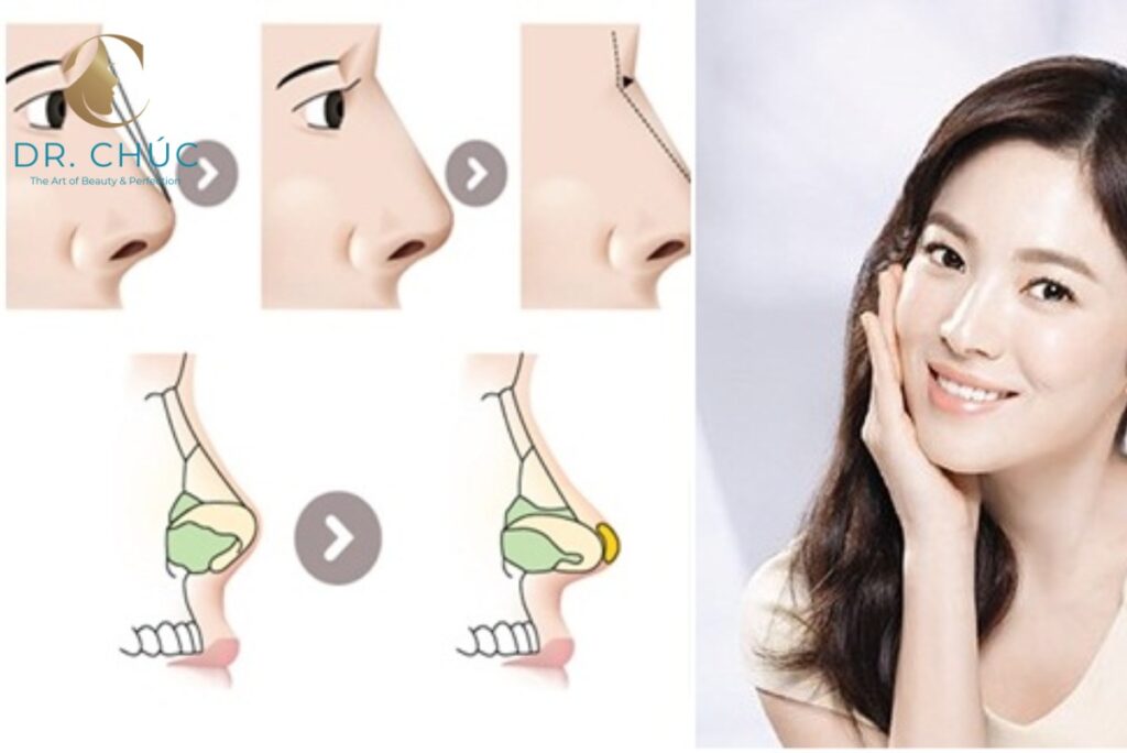 Nâng mũi cấu trúc và tính cá nhân hóa trong thẩm mỹ