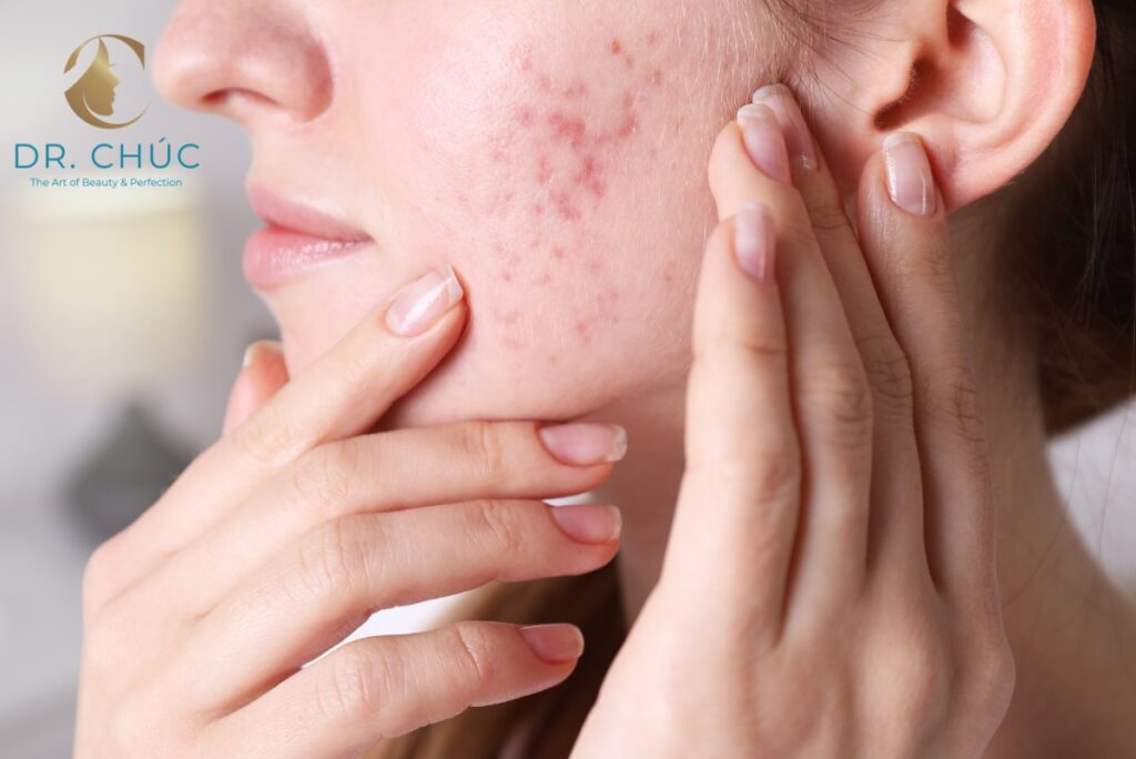Nguyên nhân gây ra mụn nội tiết