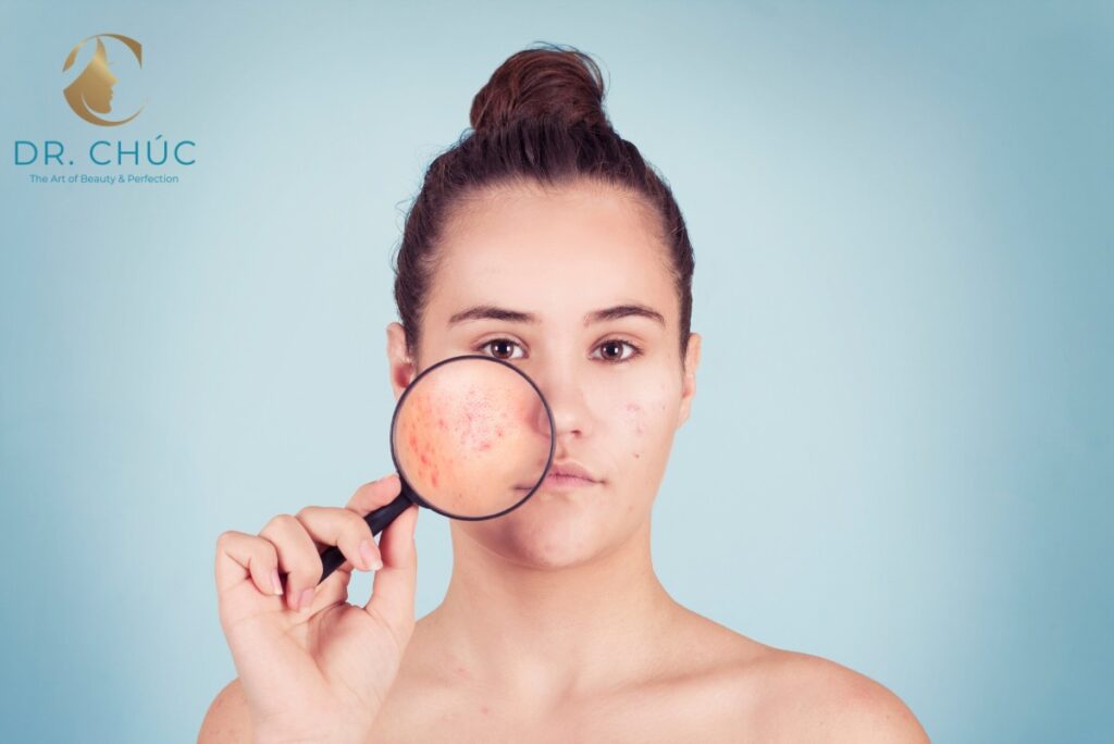 Cách phân biệt mụn nội tiết và mụn thông thường
