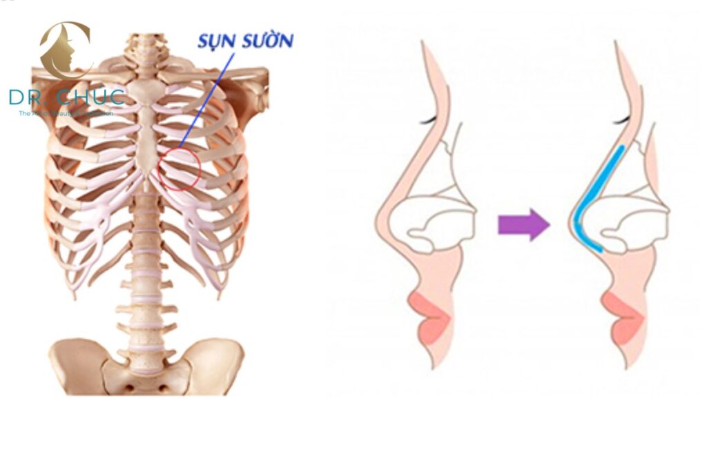 Các Triệu Chứng Thường Gặp Sau Nâng Mũi Sụn Sườn