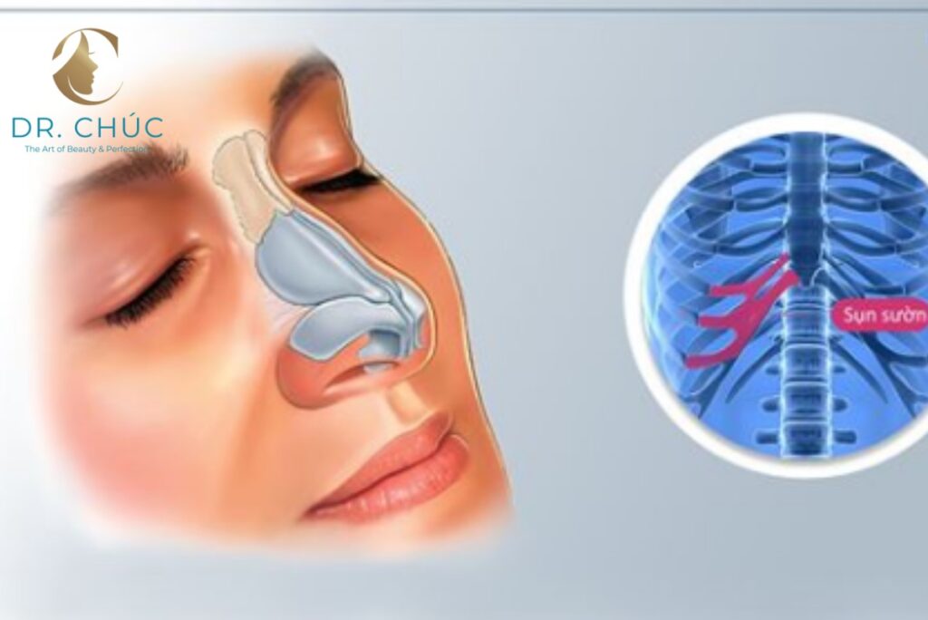 Vì Sao Cần Chăm Sóc Sau Nâng Mũi Sụn Sườn Đúng Cách?