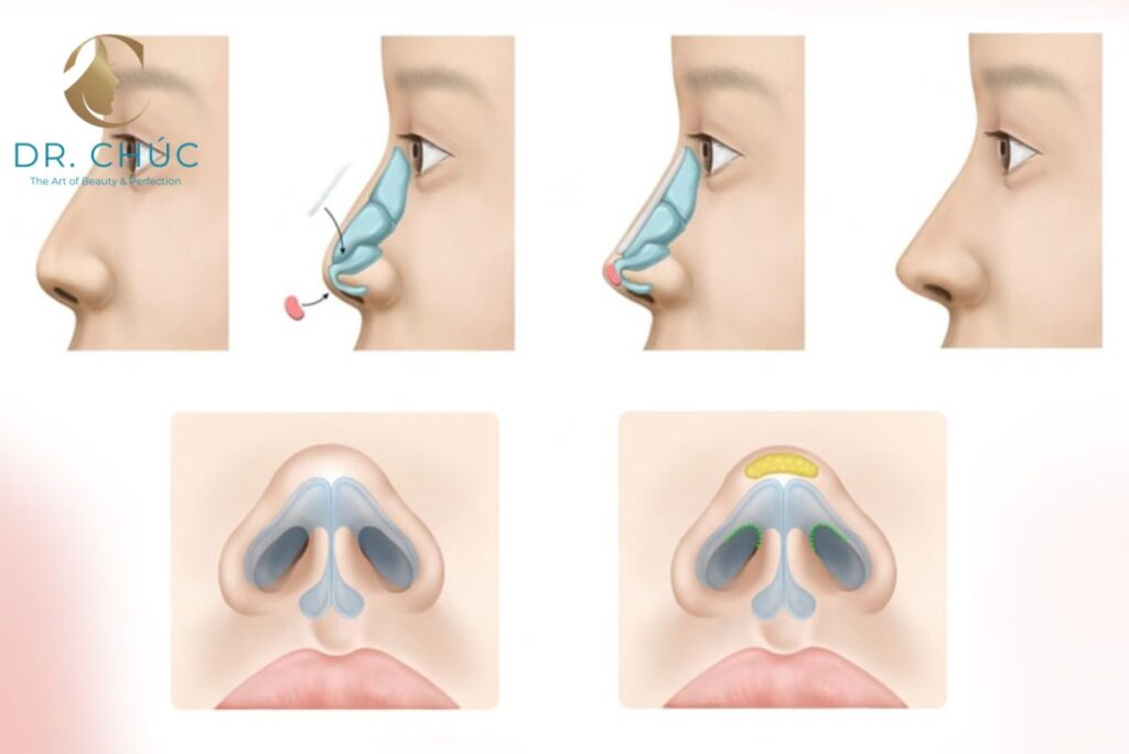 Vì sao giới trẻ chọn nâng mũi cấu trúc thay filler?