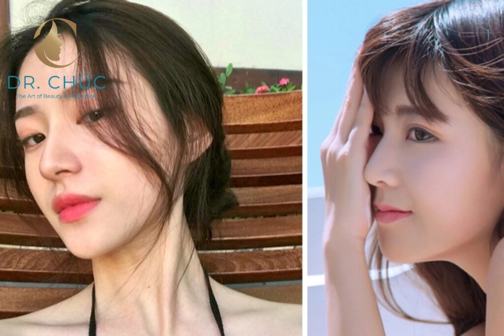 Vì sao hành trình thay đổi sau nâng mũi lại đặc biệt