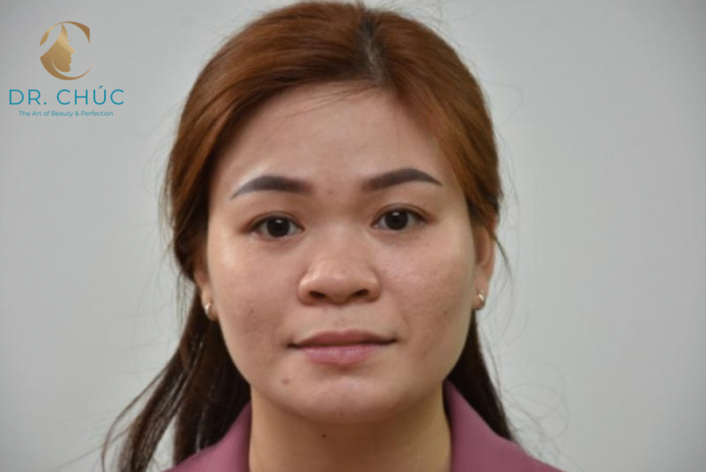 Mũi tẹt ảnh hưởng đến ngoại hình ra sao?