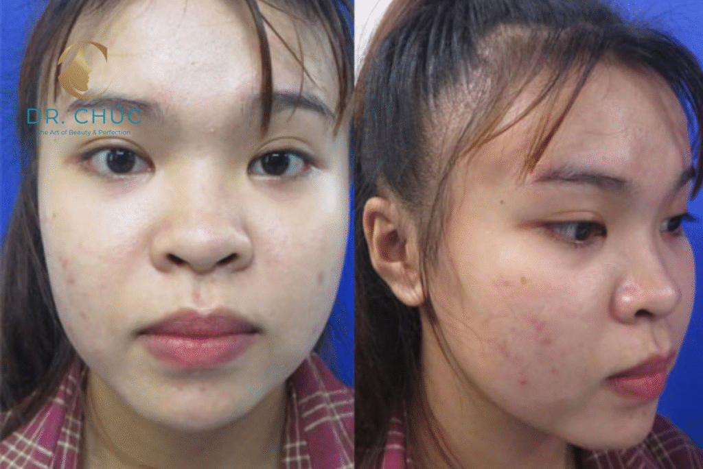 Mũi tẹt và sức khỏe hô hấp