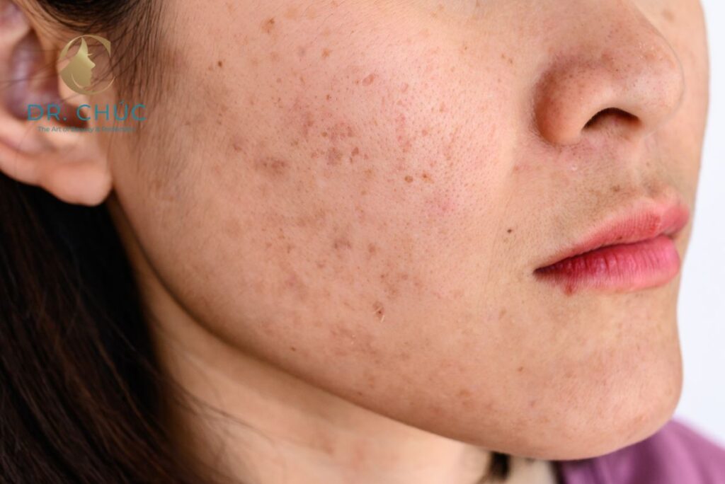 Nám nội tiết là gì?