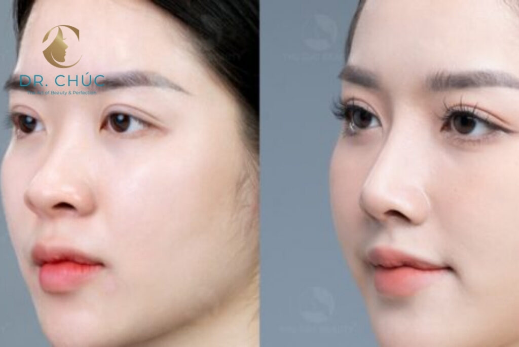 Rủi ro khi nâng mũi quá sớm