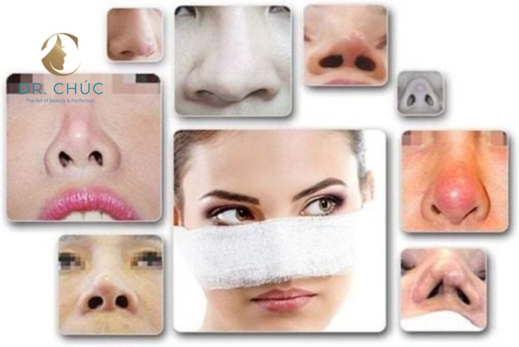 Yêu cầu của một chiếc mũi đẹp sau khi nâng