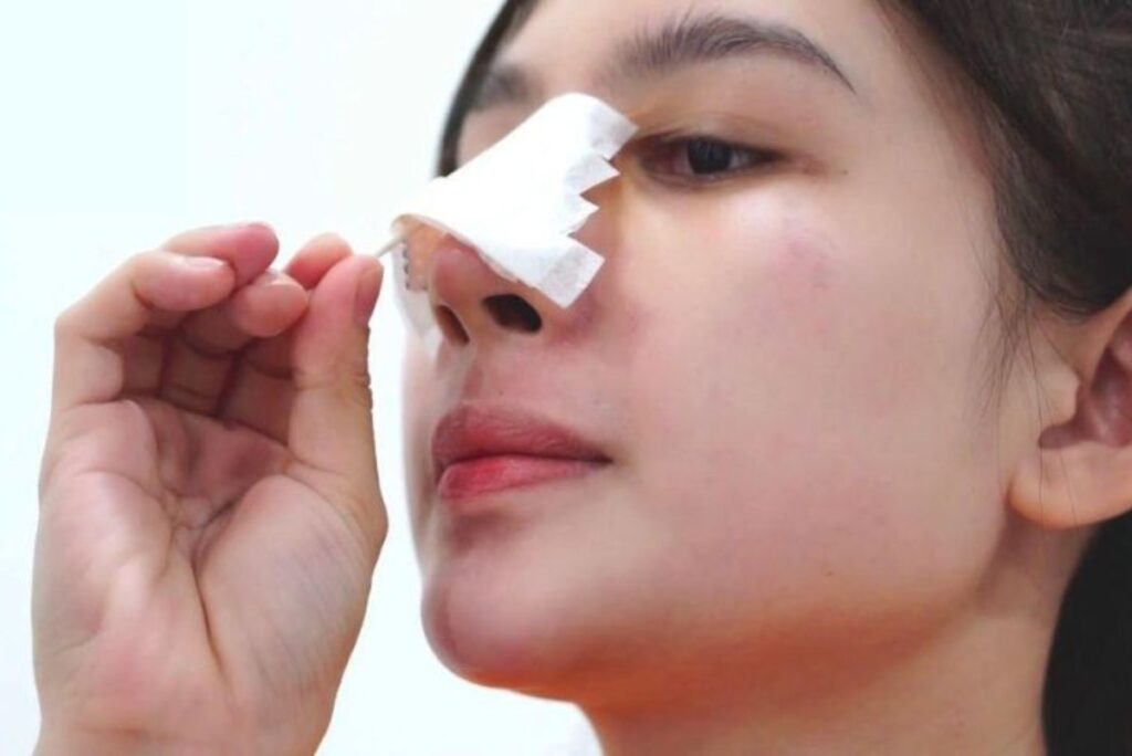 Nguyên nhân gây ra biến chứng sau nâng mũi