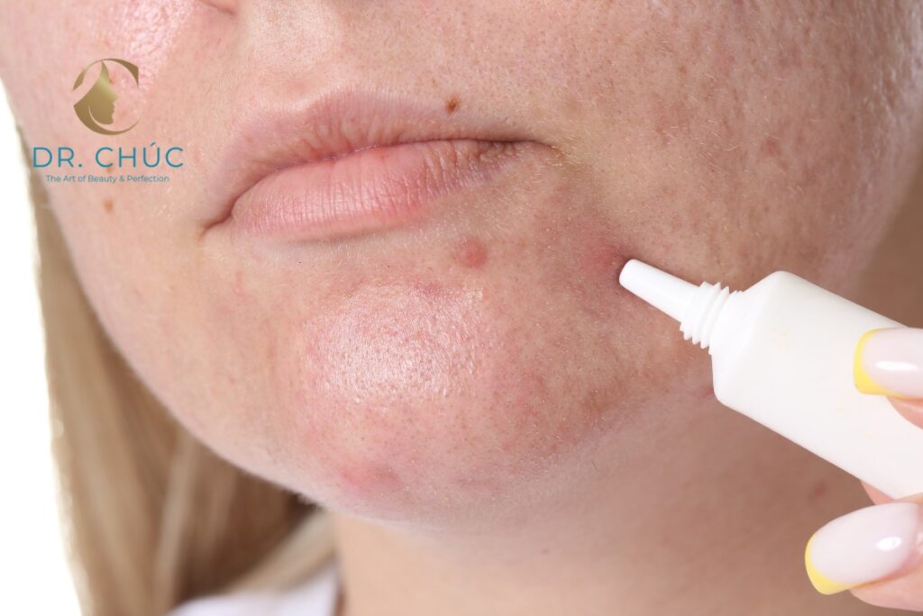 Mụn nội tiết sau sinh là gì?