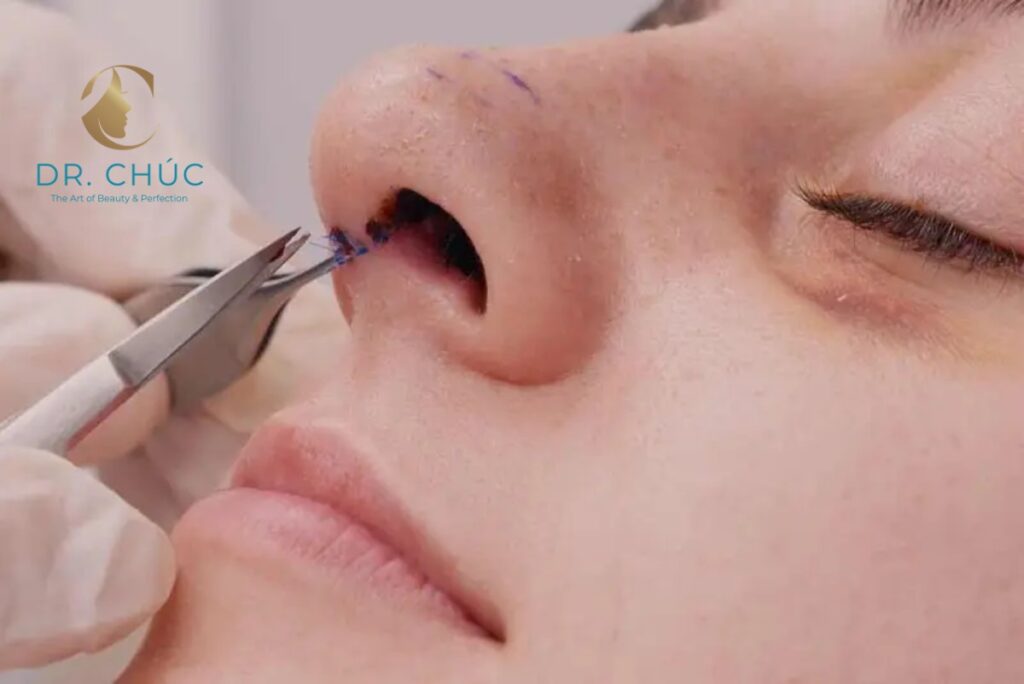 Thời điểm vàng để cắt chỉ nâng mũi