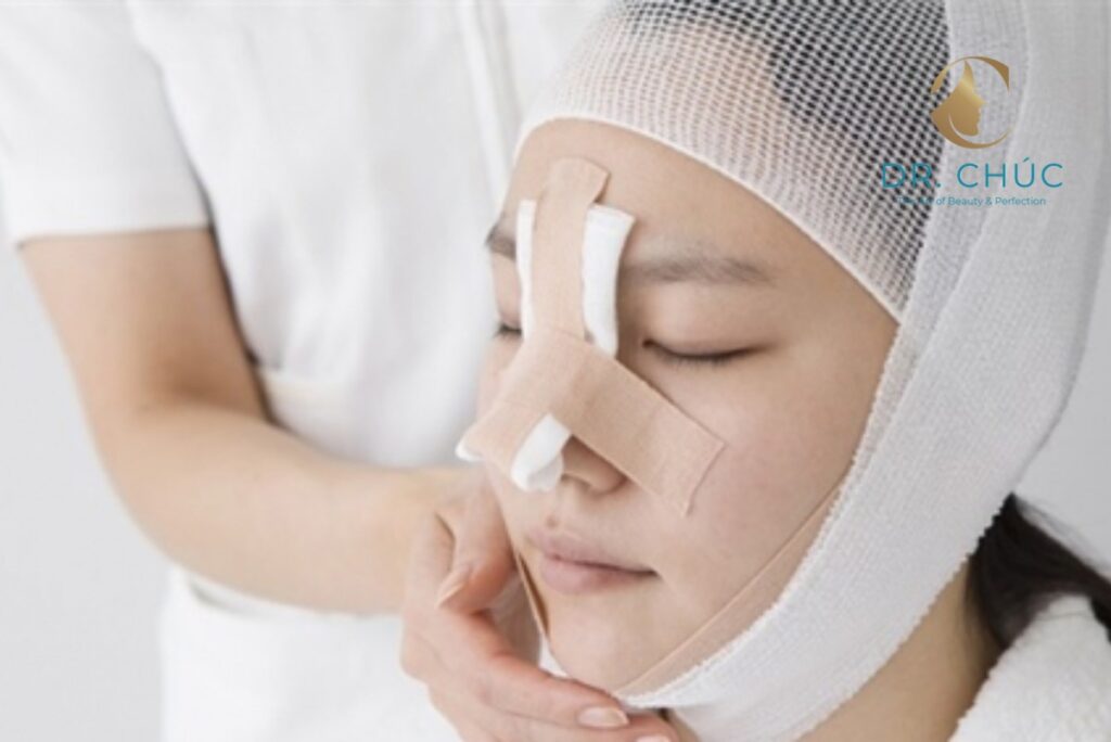 Sau khi cắt chỉ nâng mũi – giai đoạn ổn định dáng mũi