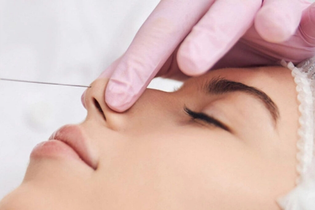 Nâng mũi bằng chỉ HIKO là gì?