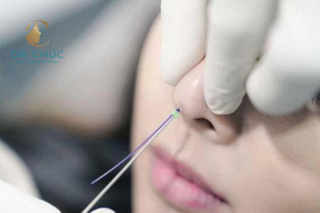 Nâng mũi bằng chỉ là gì? Cơ chế hoạt động ra sao