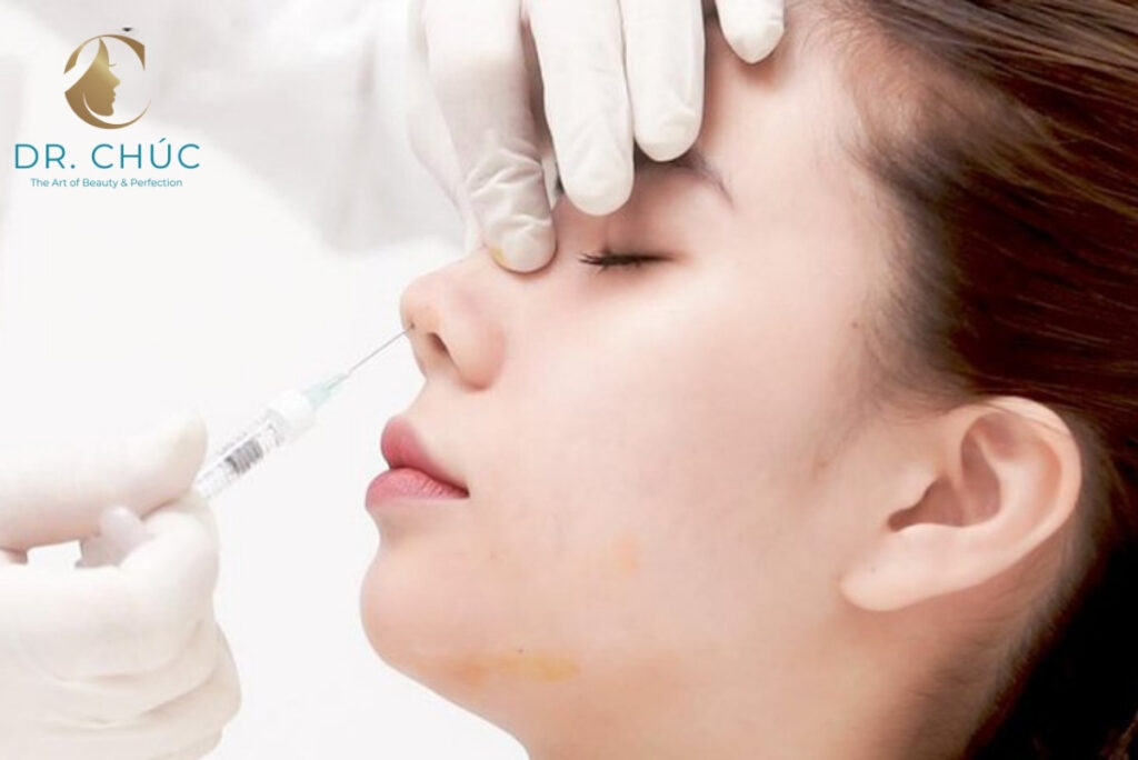 Loại chỉ nào được sử dụng trong nâng mũi bằng chỉ?