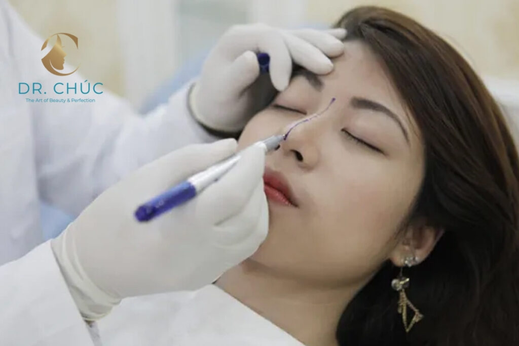 Ai phù hợp với phương pháp nâng mũi bằng chỉ?