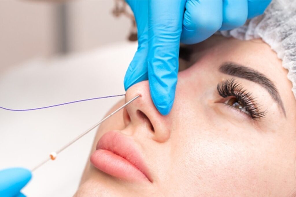 Ai phù hợp với phương pháp nâng mũi bằng chỉ