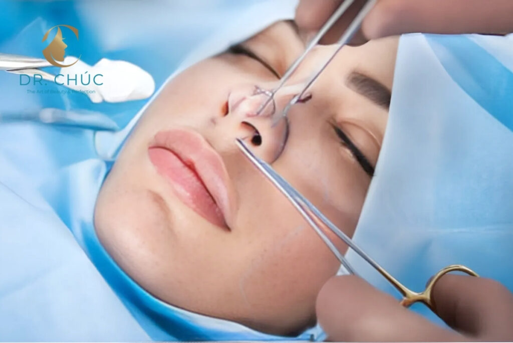 Nâng mũi bằng chỉ có an toàn không? Biến chứng có thể xảy ra