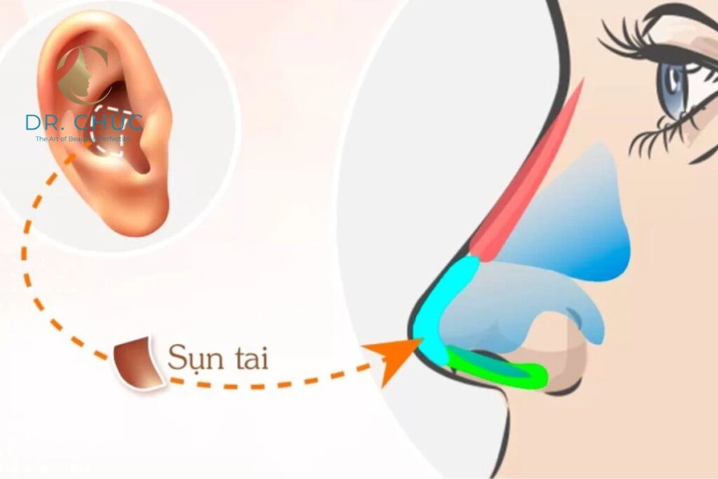 Nâng mũi bọc sụn là gì? Phương pháp phổ biến cho dáng mũi mềm mại, tự nhiên