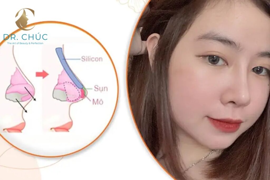Nâng mũi cấu trúc là gì? Giải pháp tái tạo toàn diện dáng mũi