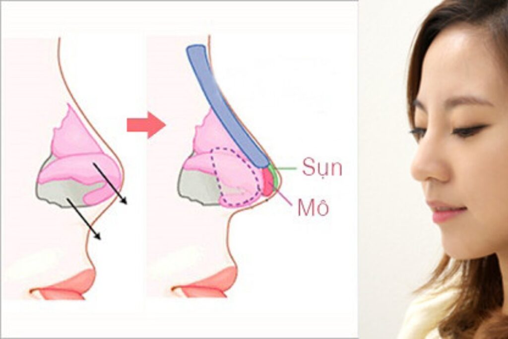 Khi nào nên chọn nâng mũi bọc sụn?
