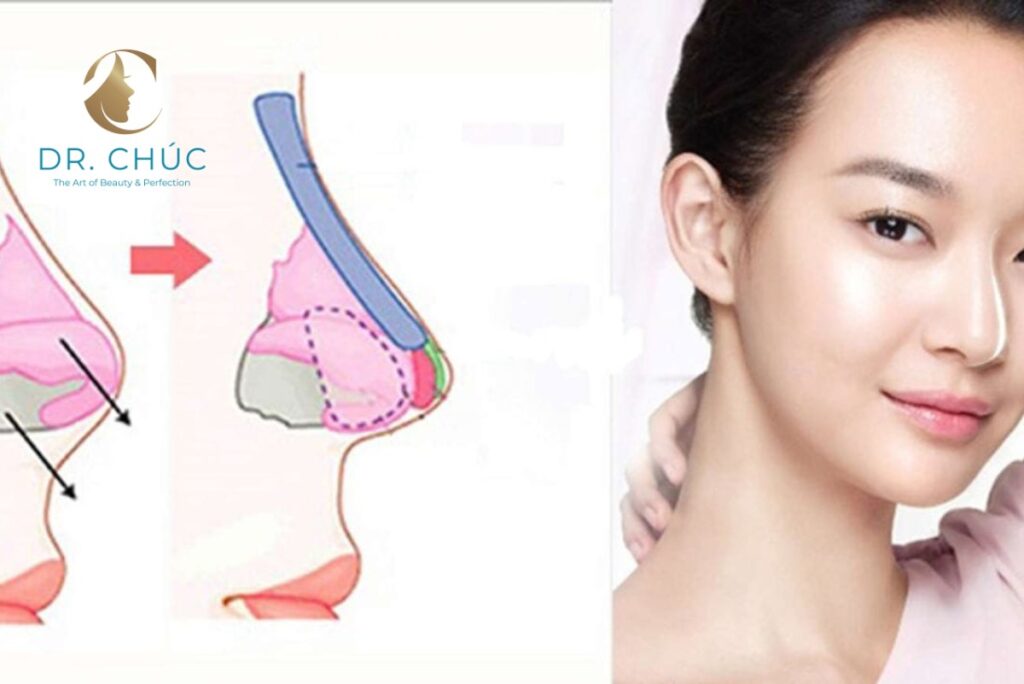 Khi nào nên chọn nâng mũi cấu trúc?