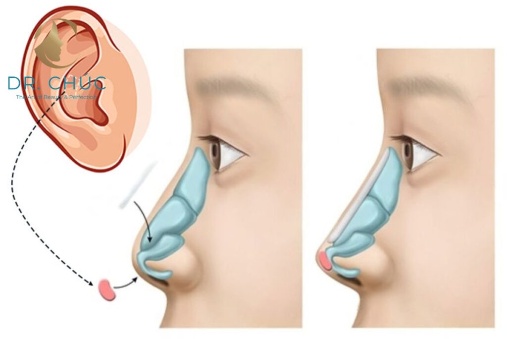 Nên nâng mũi bọc sụn hay cấu trúc để đẹp tự nhiên nhất?