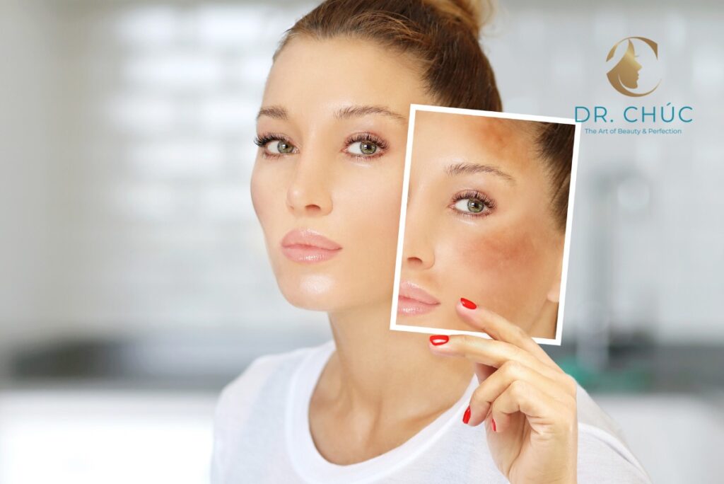 Cách khắc phục tình trạng rối loạn nội tiết tố sau sinh gây nám da