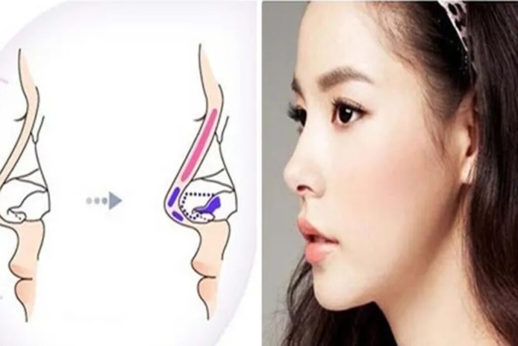 Teo mũi sau nâng mũi sụn sườn: hiểu đúng bản chất