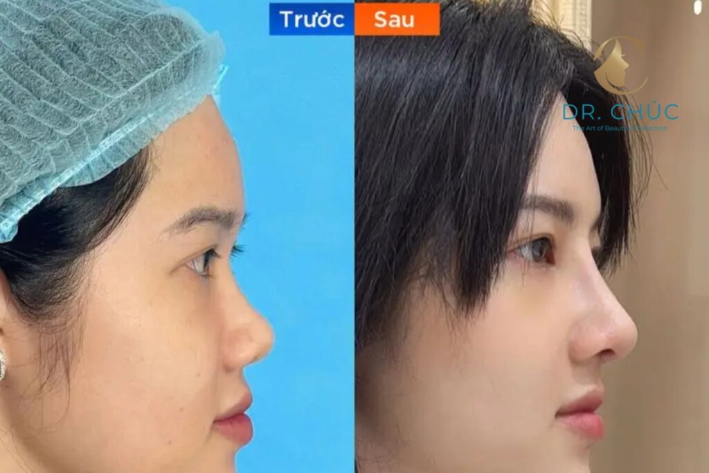 Khi nào cân nhắc nâng mũi lần 2?