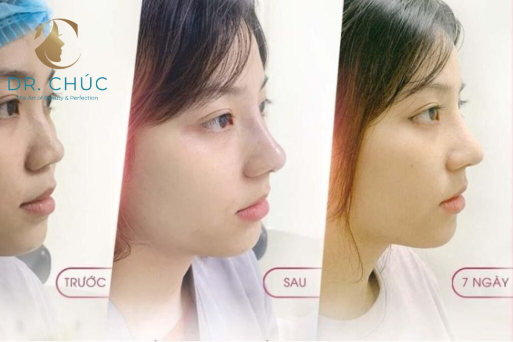 Lời khuyên chăm sóc để hạn chế nguy cơ co ngót