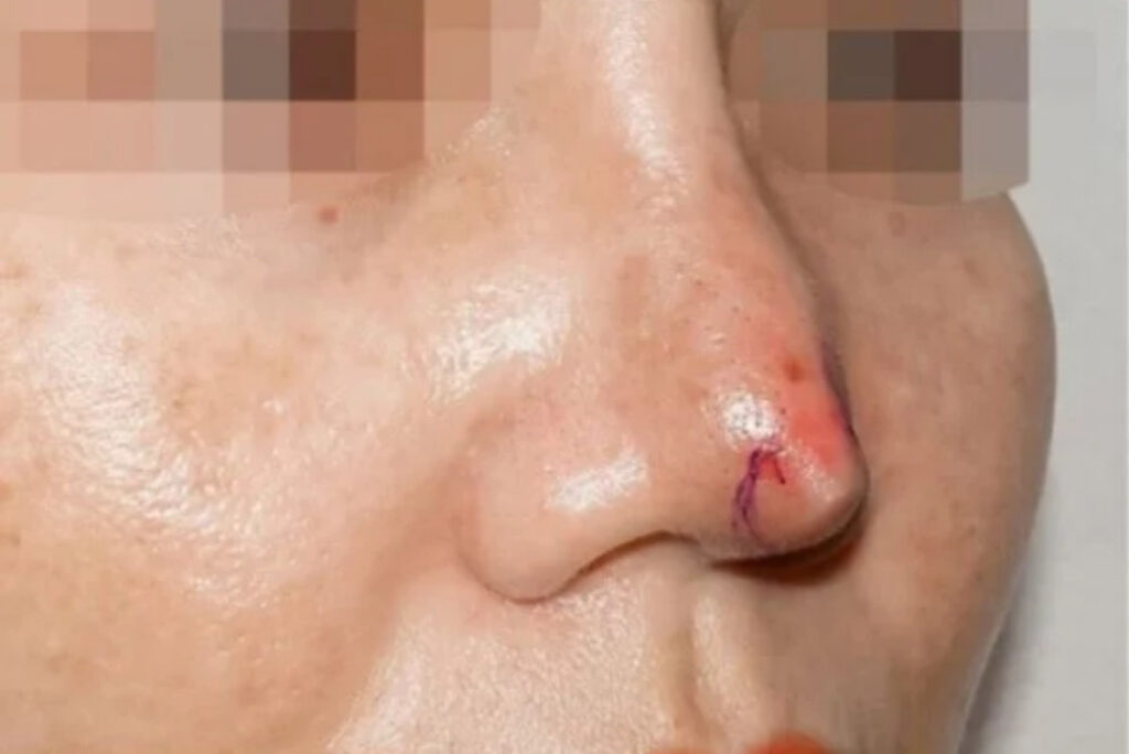 Tụt sụn mũi là gì? Biến chứng này nguy hiểm đến đâu?