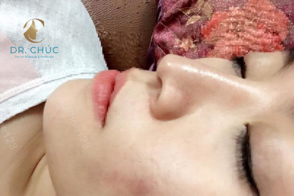 Dấu hiệu nhận biết sớm tụt sụn mũi – Cảnh báo từ bác sĩ