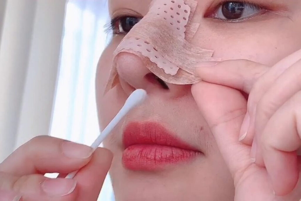 Nguyên nhân khiến vết khâu nâng mũi đóng vảy