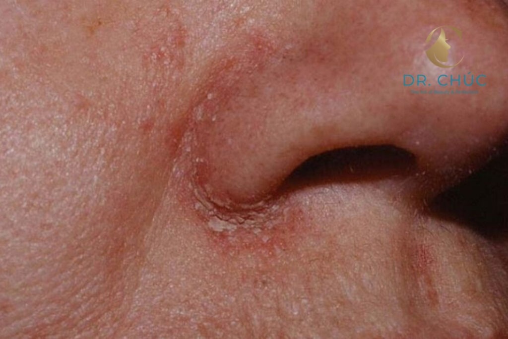 Phòng ngừa vết khâu nâng mũi đóng vảy ngay từ đầu