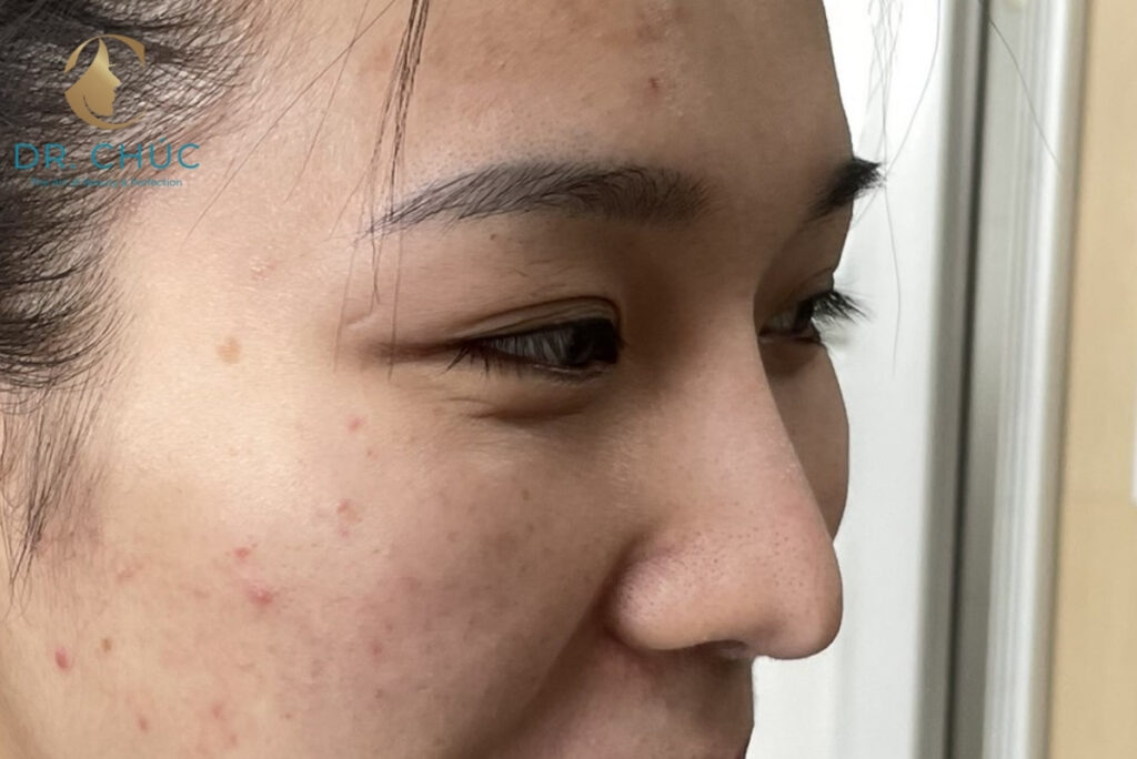 Nguyên nhân gây tụt sụn mũi