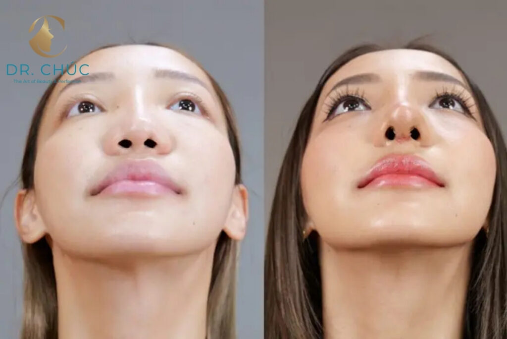 Da mũi mỏng là gì? Nhận biết và nguyên nhân