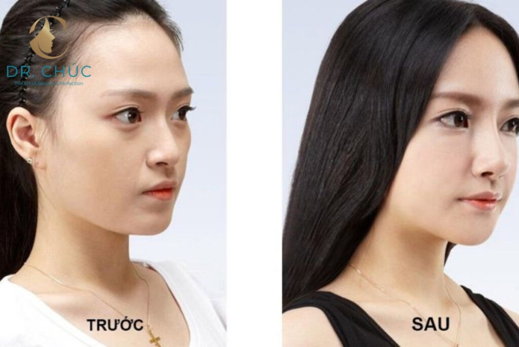 Da mũi mỏng có nâng mũi được không? Điều kiện và lưu ý