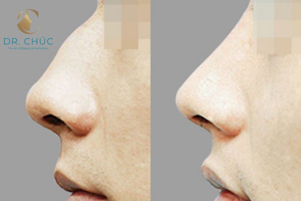 Mài gồ mũi là gì? Hiểu đúng về bản chất của kỹ thuật này