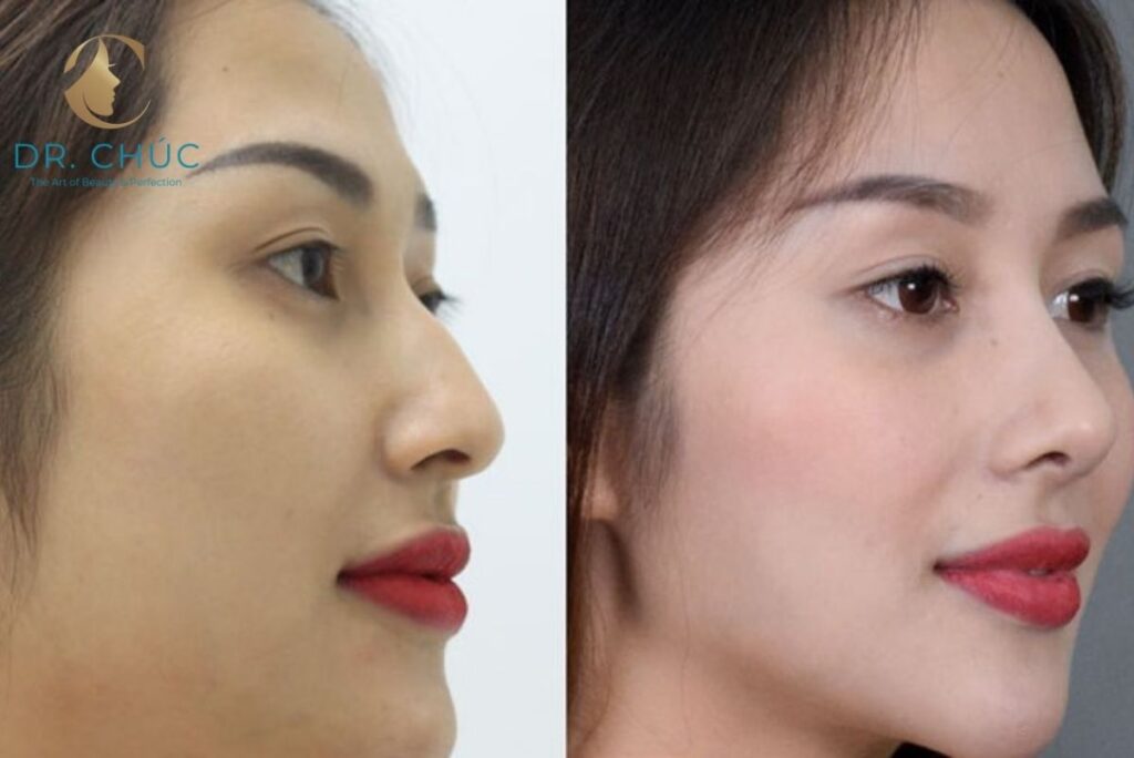 Dấu hiệu nhận biết mũi bị gồ và những ảnh hưởng đến thẩm mỹ