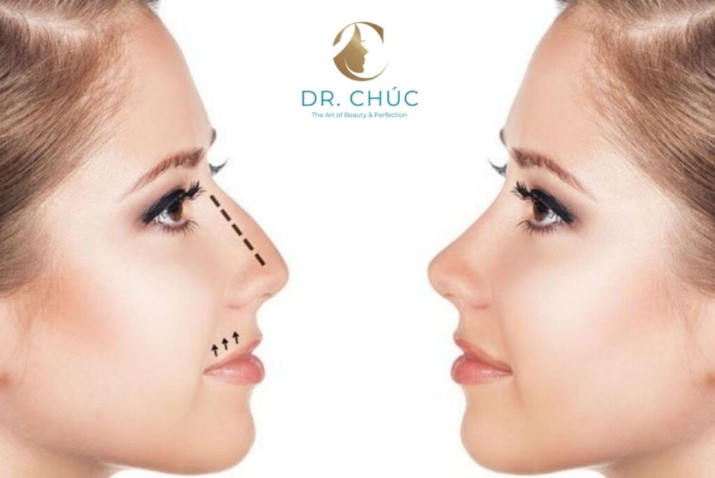 Có nên mài gồ mũi không? Ai phù hợp với kỹ thuật này?