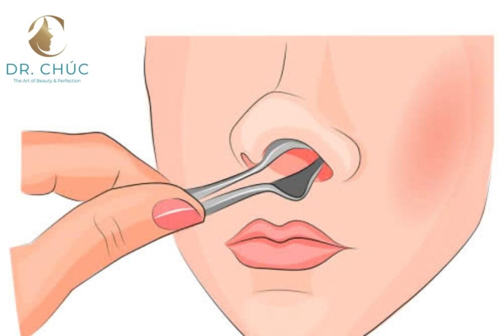 Hiện tượng nâng mũi bị nổi cục trong lỗ mũi là gì?