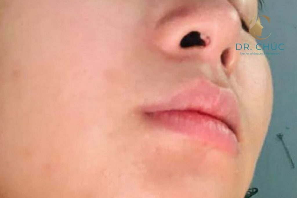 Cách xử lý nâng mũi bị nổi cục trong lỗ mũi