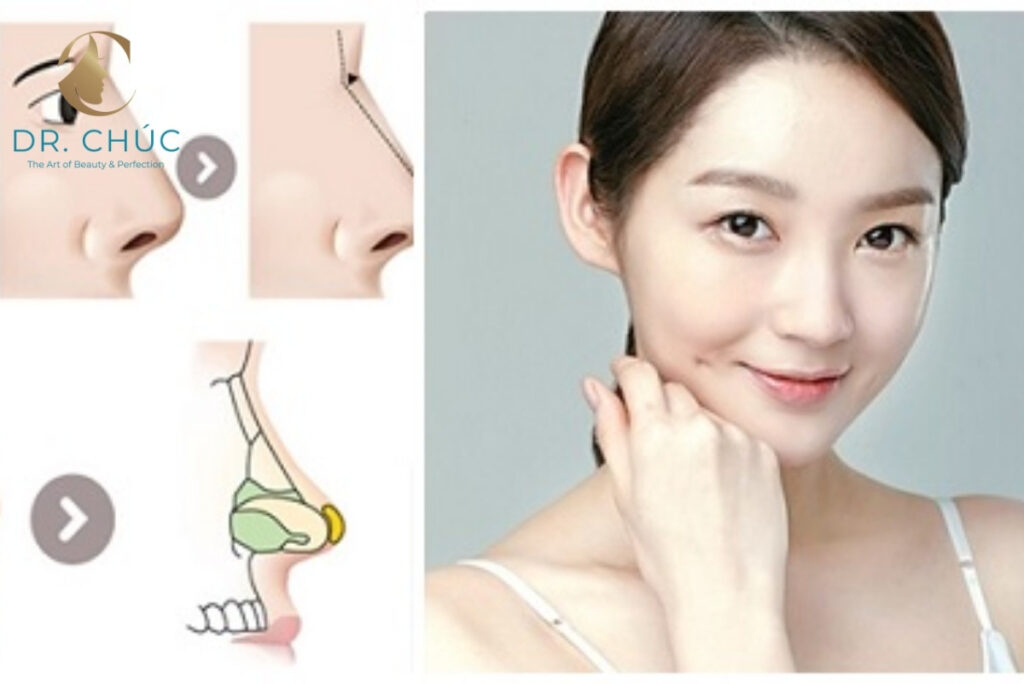 Nâng mũi có thay đổi khuôn mặt không?