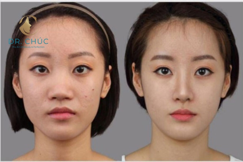 Những biến chứng có thể xảy ra khi nâng mũi sai cách